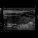 Hashitomo thyreoiditis: US - Ultrasound
